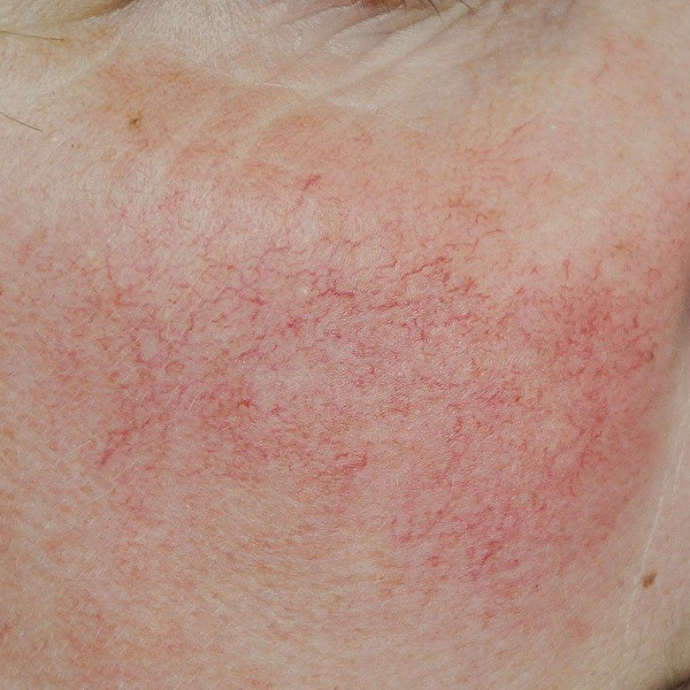 dermatologie-esthetique-couperose-visage