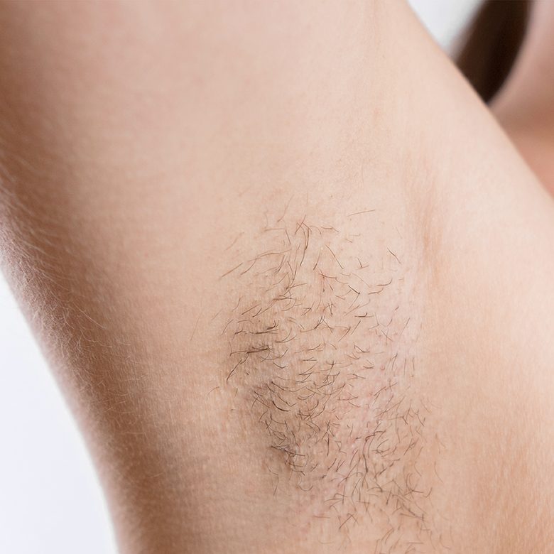 Woman,With,Armpit,Hair,,Female,Hairy,Armpit,,Before,And,After