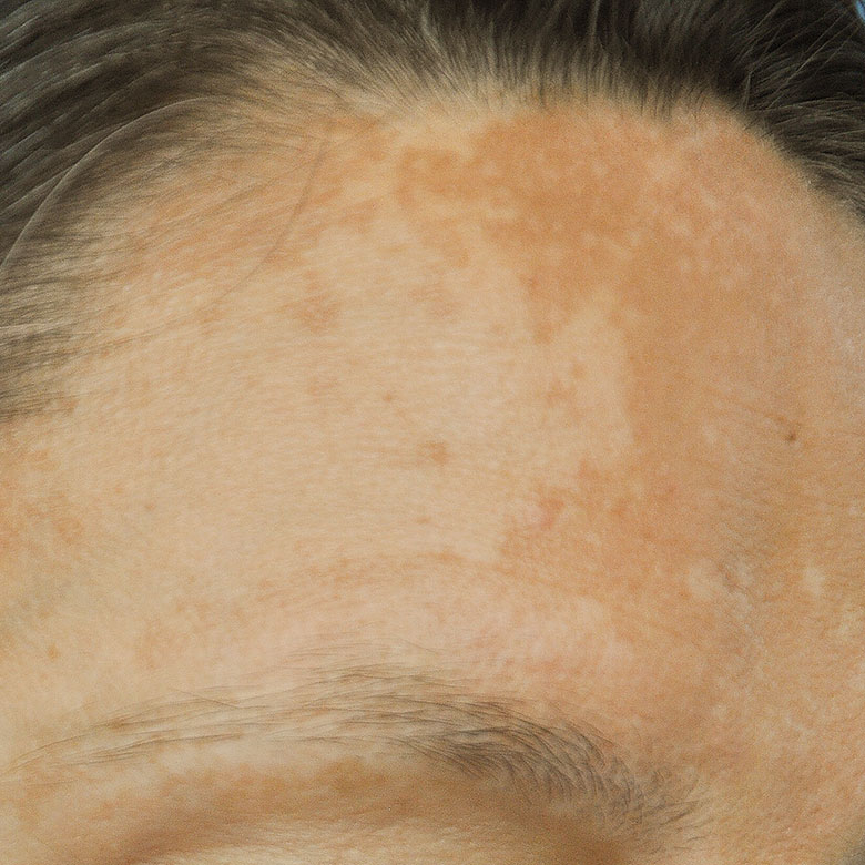 dermatologie-esthetique-taches-visage