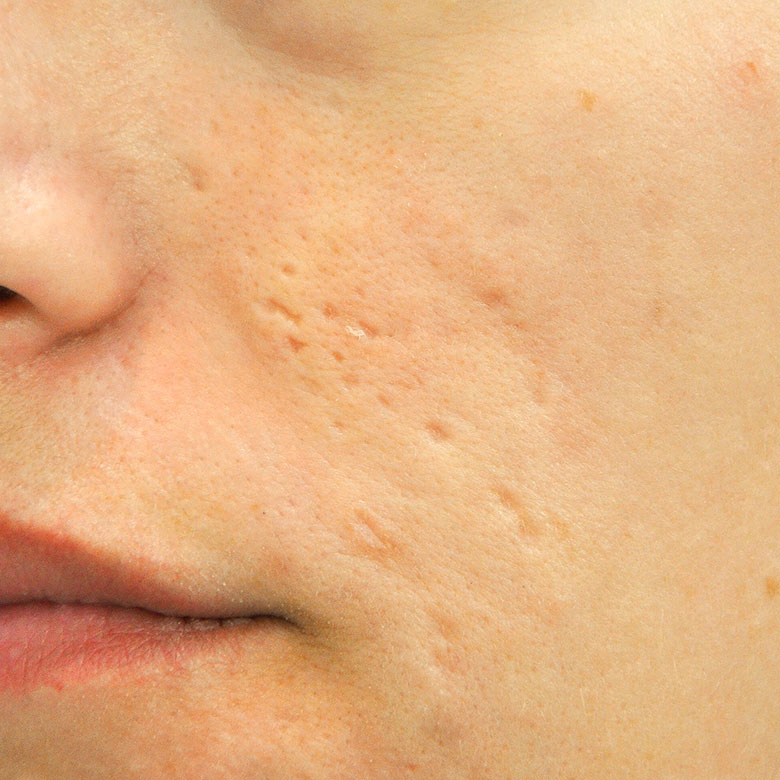 dermatologie-esthetique-acne