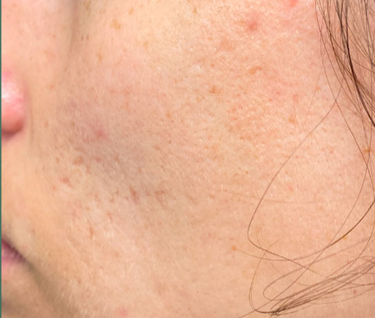 avant-cicatrice-acne-esthetique-nantes